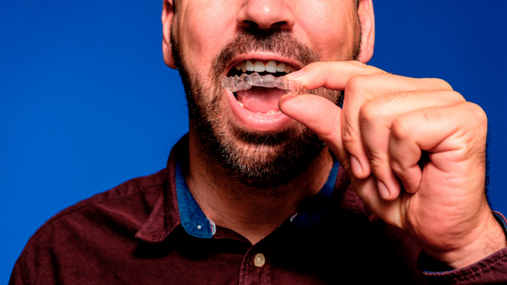 clear aligners